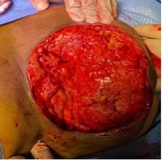 Necrotizing fasciitis of the breast