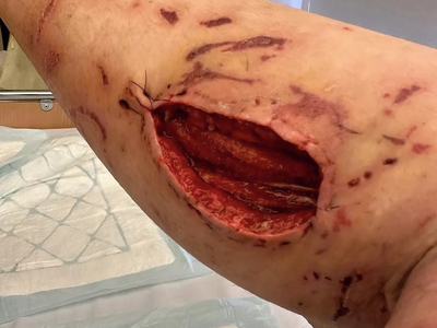 Foreign soldier fighting alongside UA hit by Russian bomb shrapnel