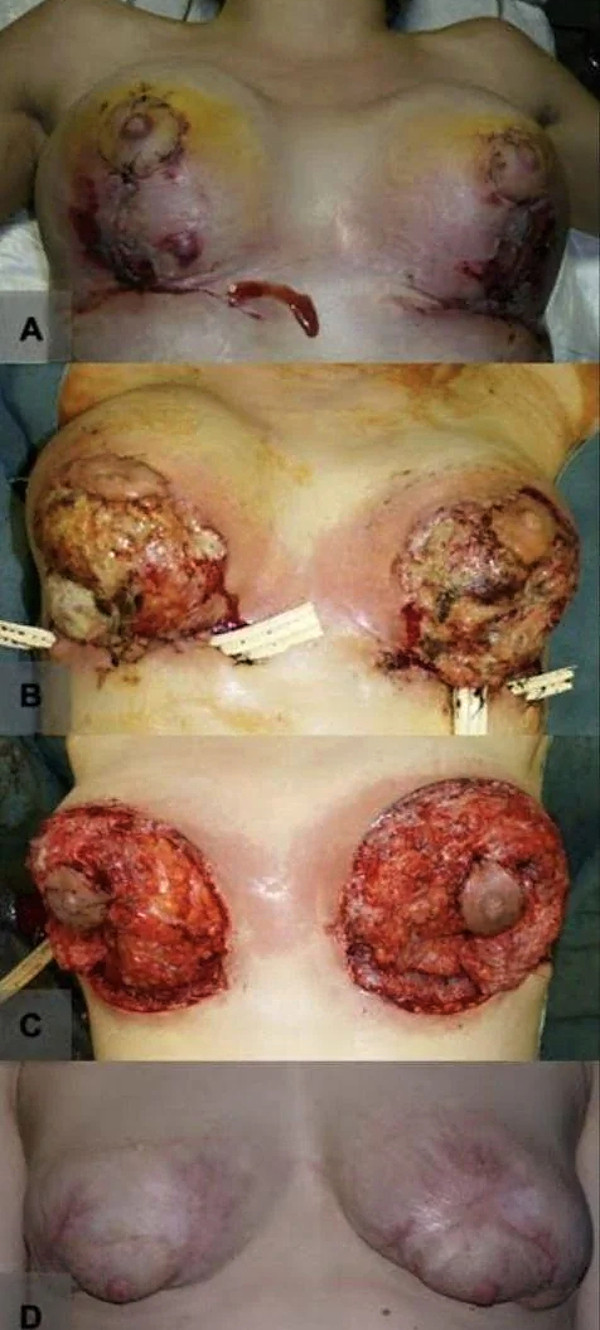 Pyoderma Gangrenosum After Breast Reduction