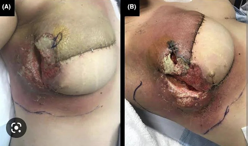 Pyoderma Gangrenosum After Breast Reduction