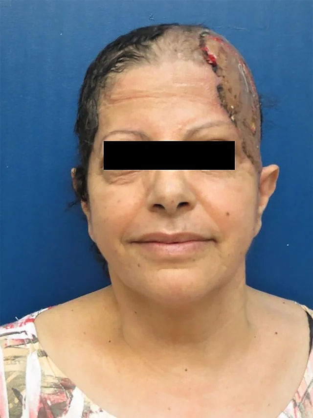 Multiple myeloma of the scalp