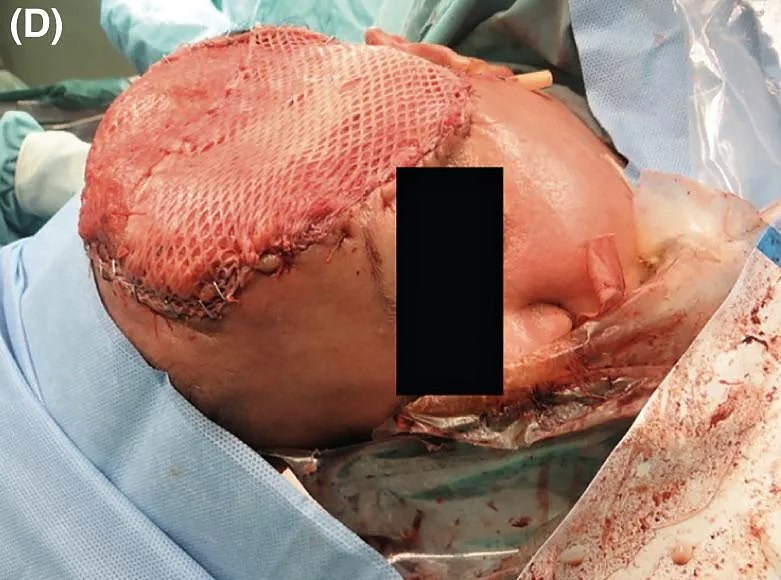 Multiple myeloma of the scalp