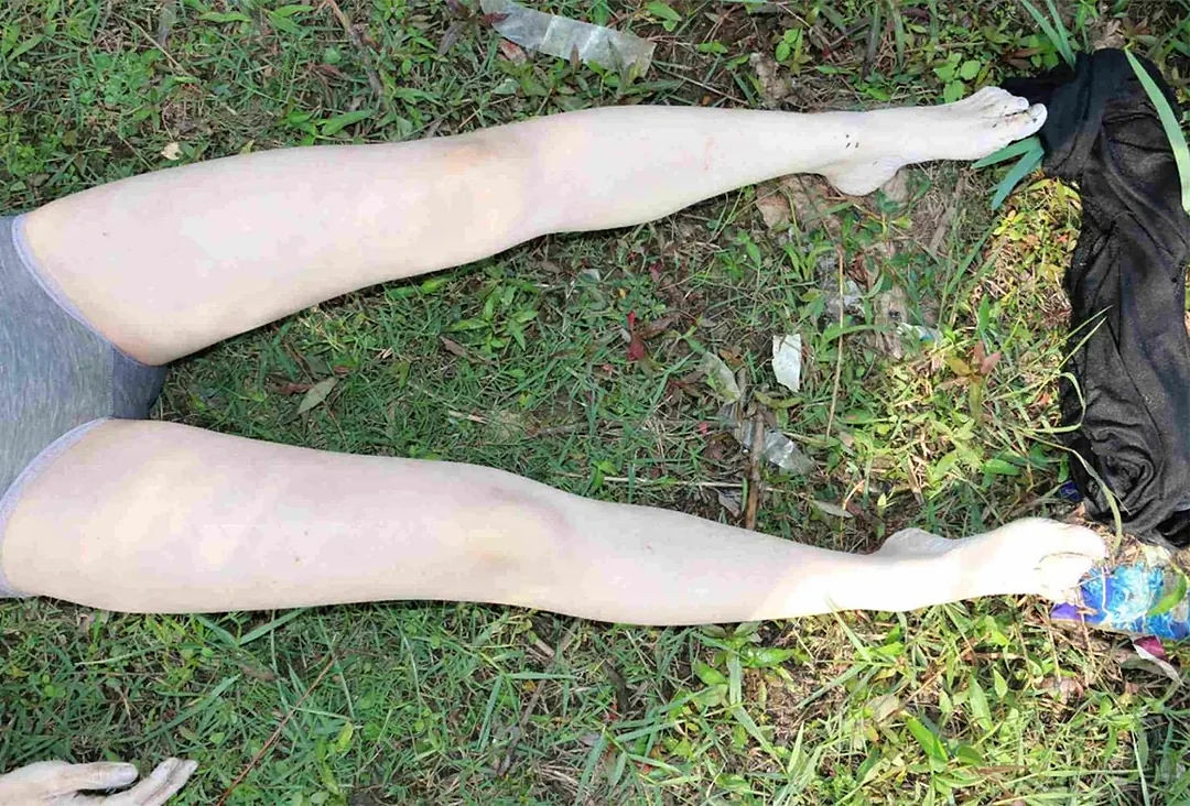 21 Year Old Murder by Drowning Woman Forensic Exam