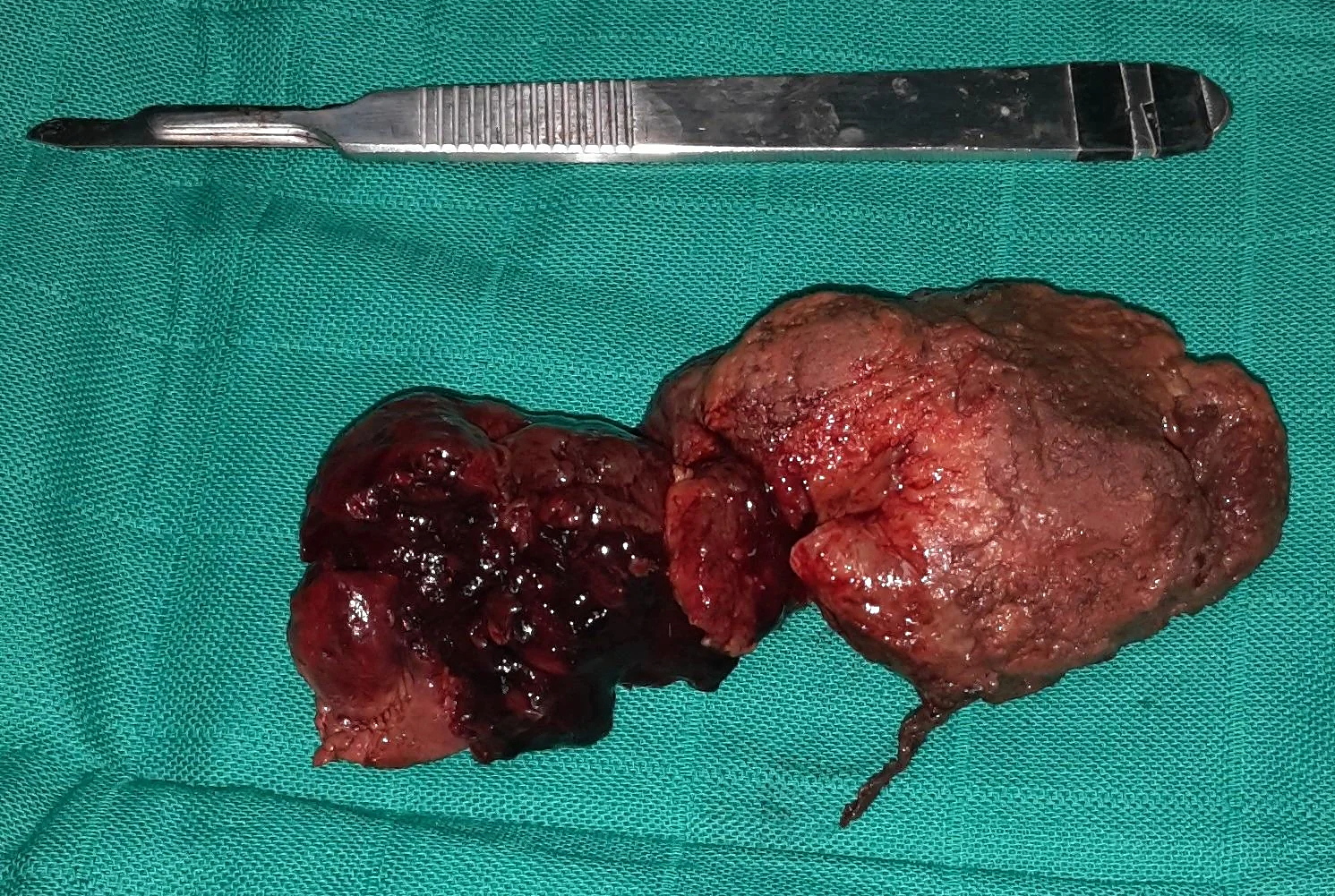 An “enormous” gossypiboma