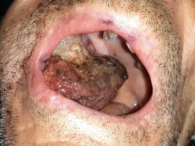 An “enormous” gossypiboma