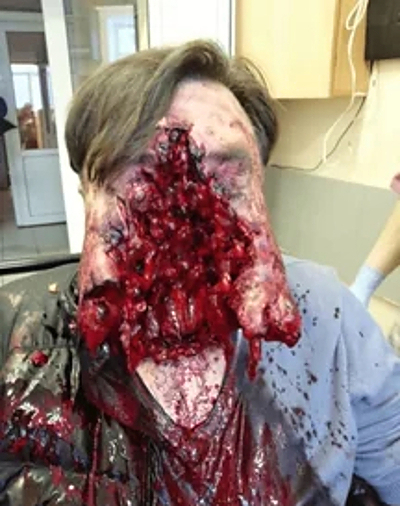 Compilation of shotgun wounds