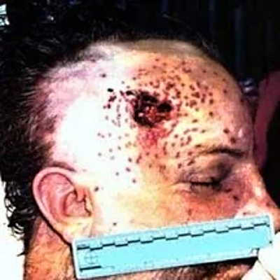 Compilation of shotgun wounds