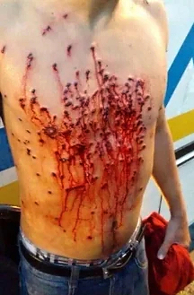 Compilation of shotgun wounds