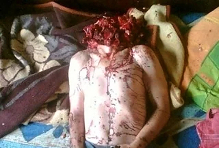 Compilation of shotgun wounds