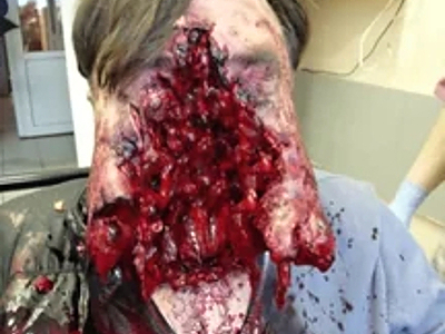 Compilation of shotgun wounds