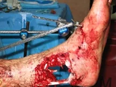 Compilation of shotgun wounds