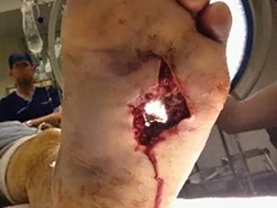 Compilation of shotgun wounds