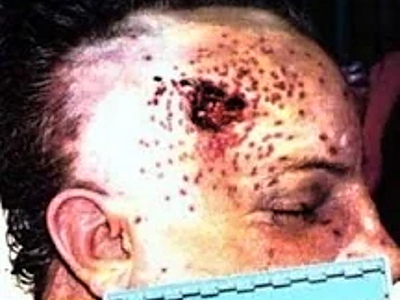 Compilation of shotgun wounds