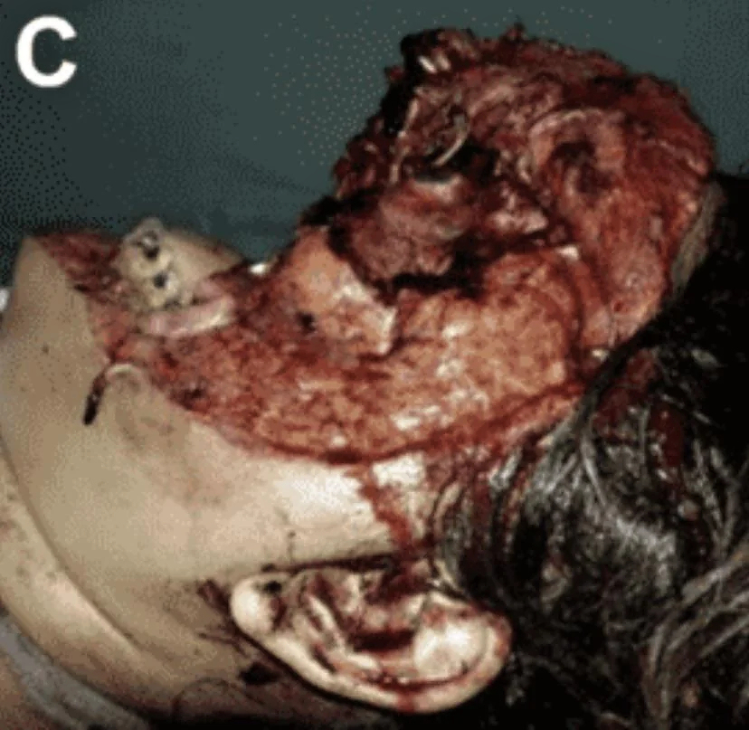 Face entirely reconstructed after accident