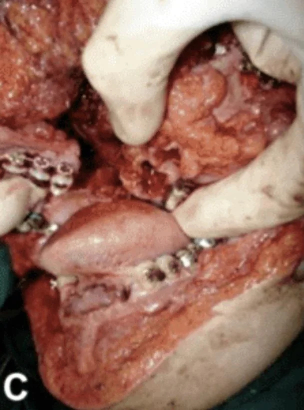 Face entirely reconstructed after accident