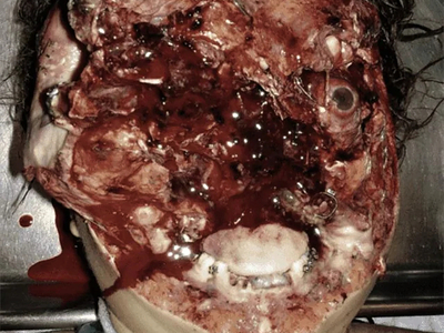 Face entirely reconstructed after accident