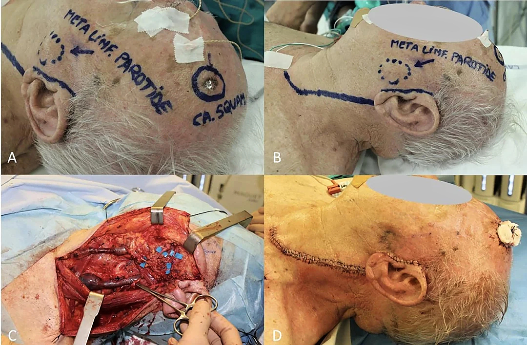 Locally advanced squamous cell carcinomas