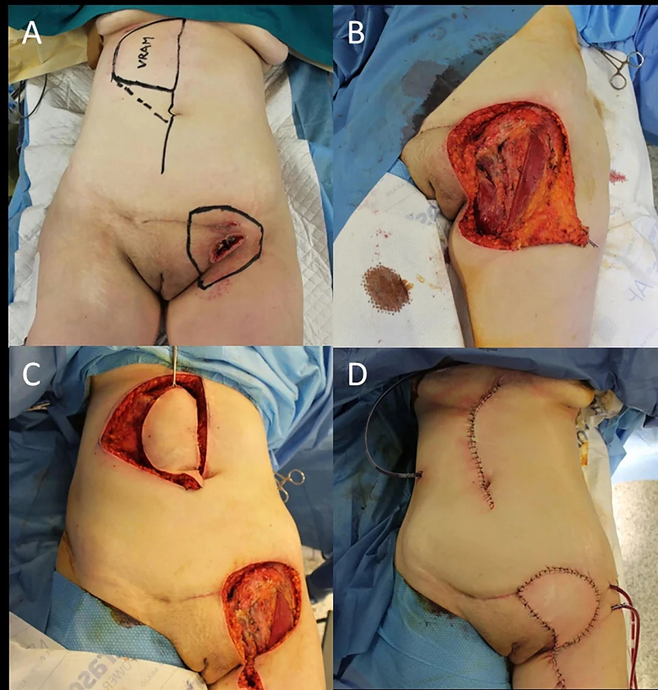 Locally advanced squamous cell carcinomas