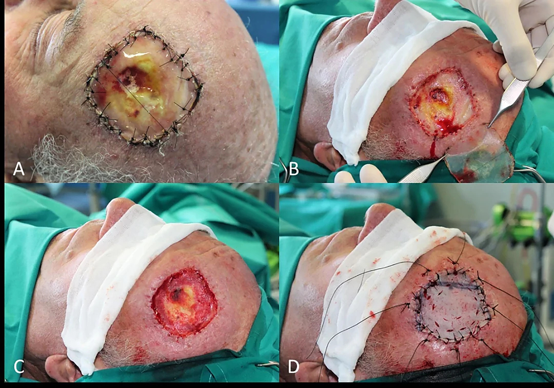 Locally advanced squamous cell carcinomas