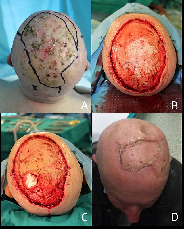 Locally advanced squamous cell carcinomas