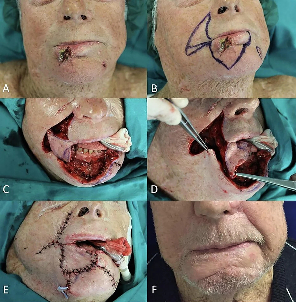 Locally advanced squamous cell carcinomas
