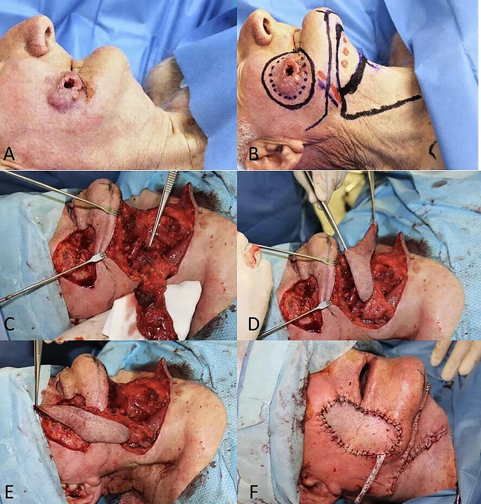 Locally advanced squamous cell carcinomas