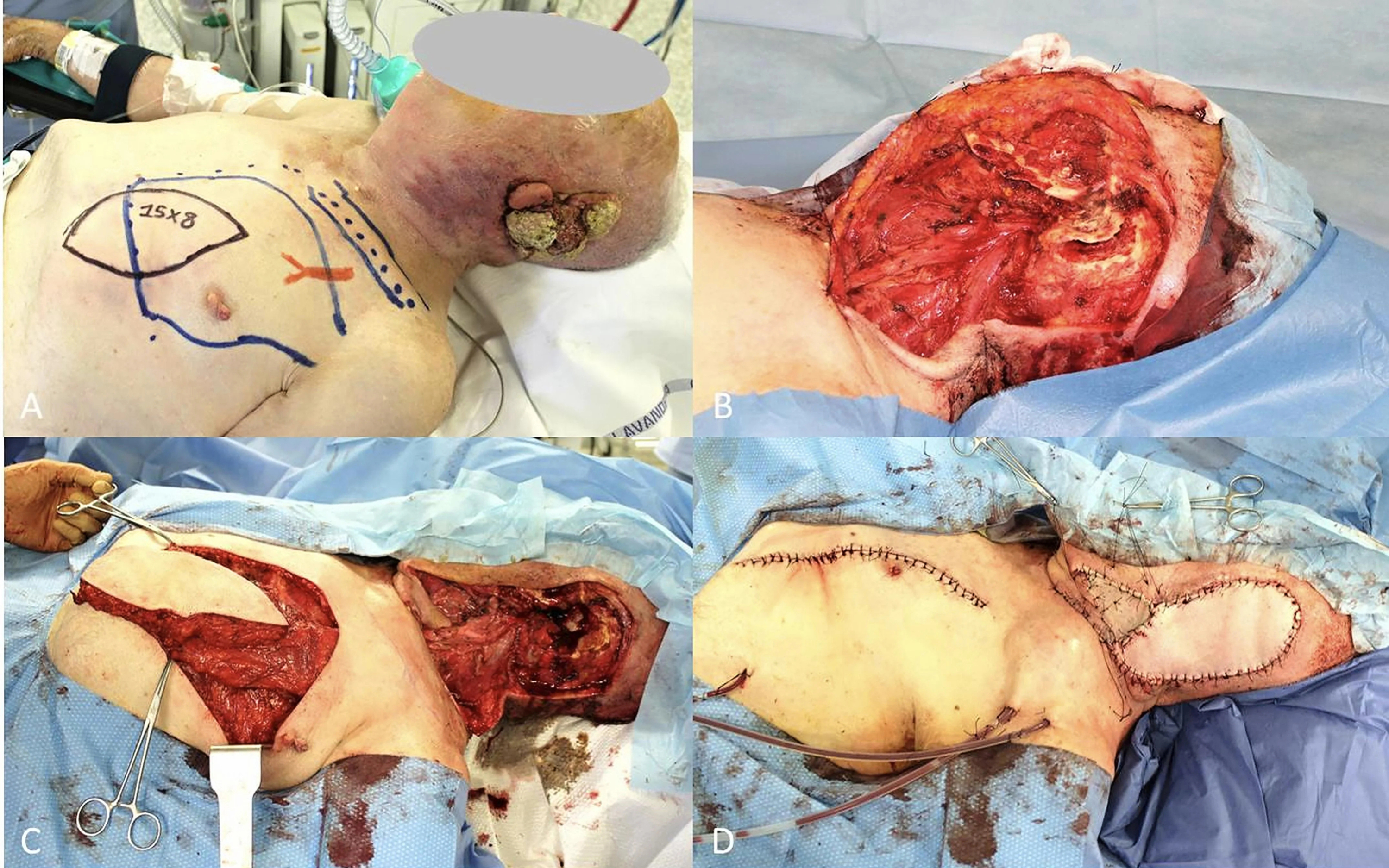 Locally advanced squamous cell carcinomas