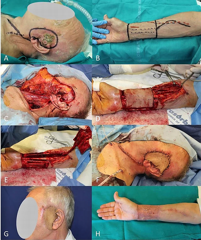 Locally advanced squamous cell carcinomas