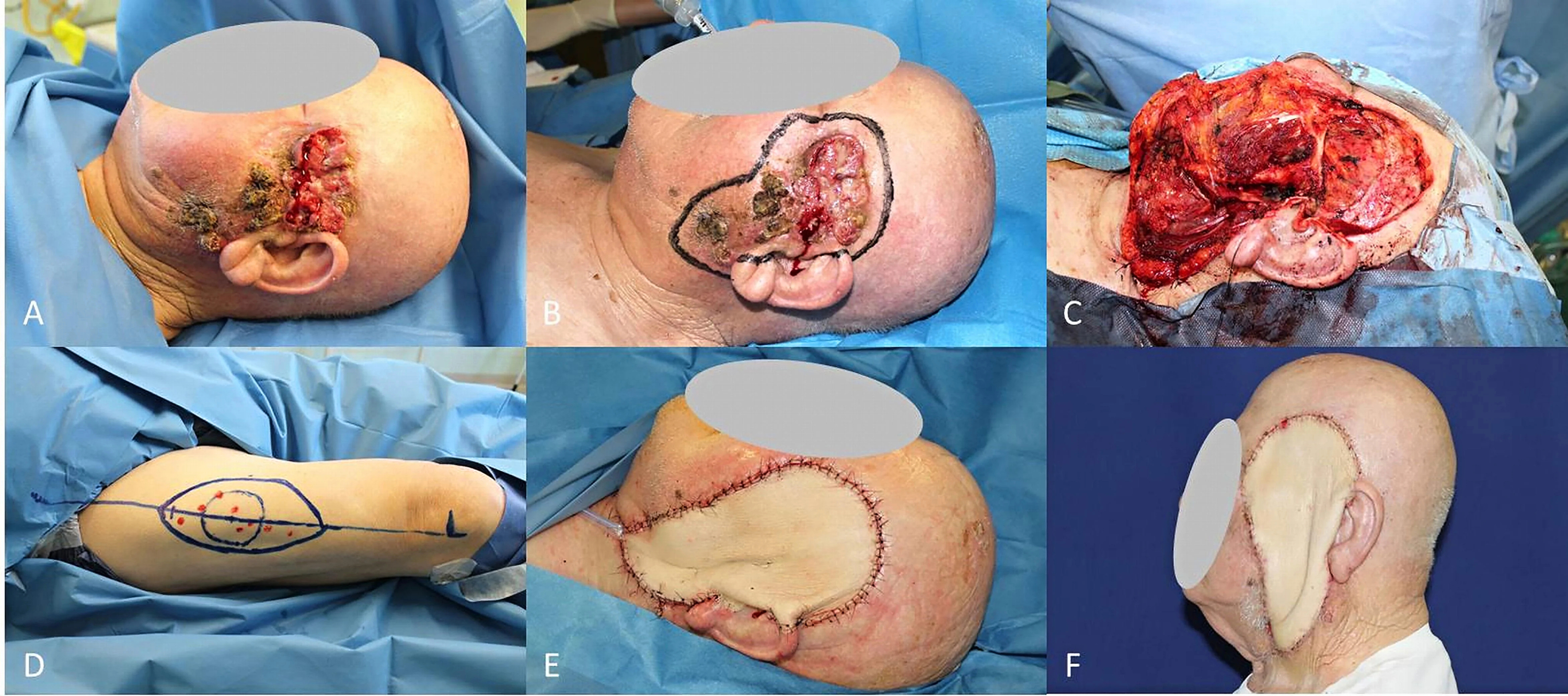 Locally advanced squamous cell carcinomas