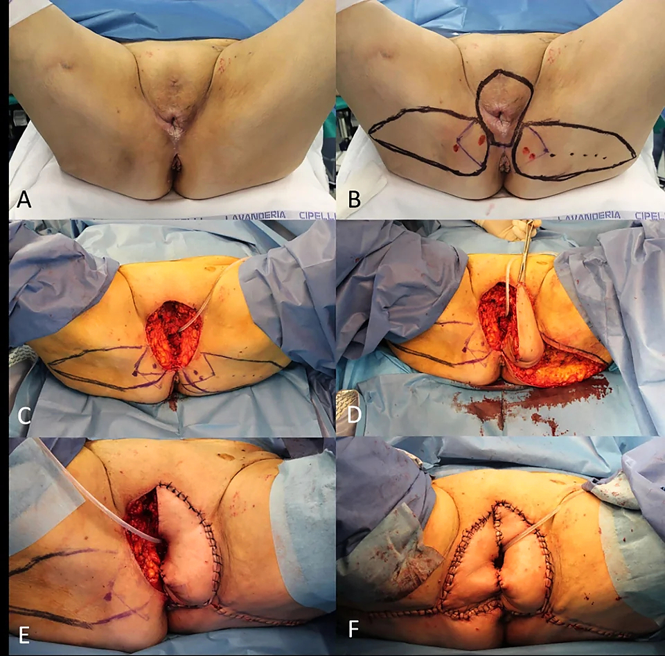 Locally advanced squamous cell carcinomas