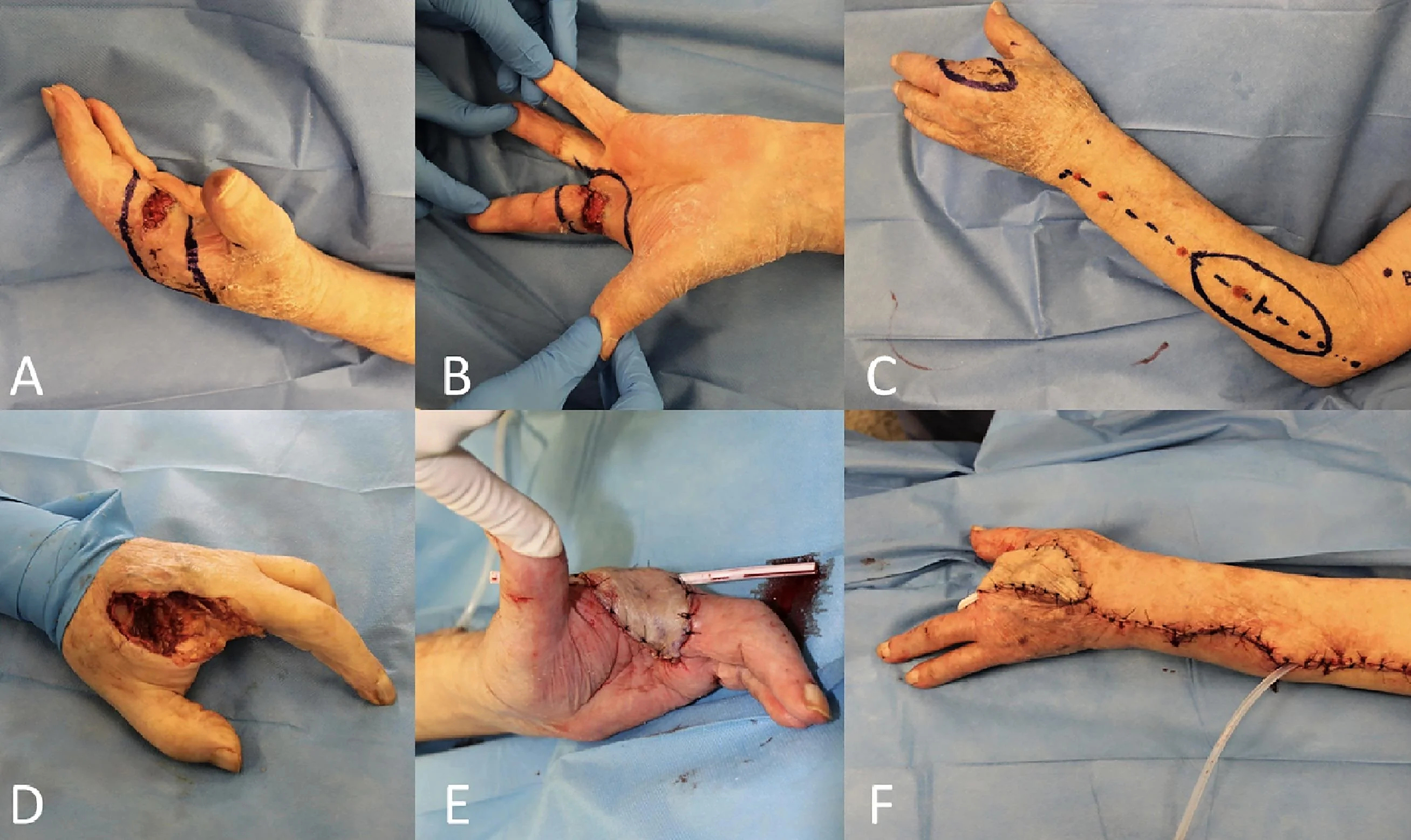 Locally advanced squamous cell carcinomas