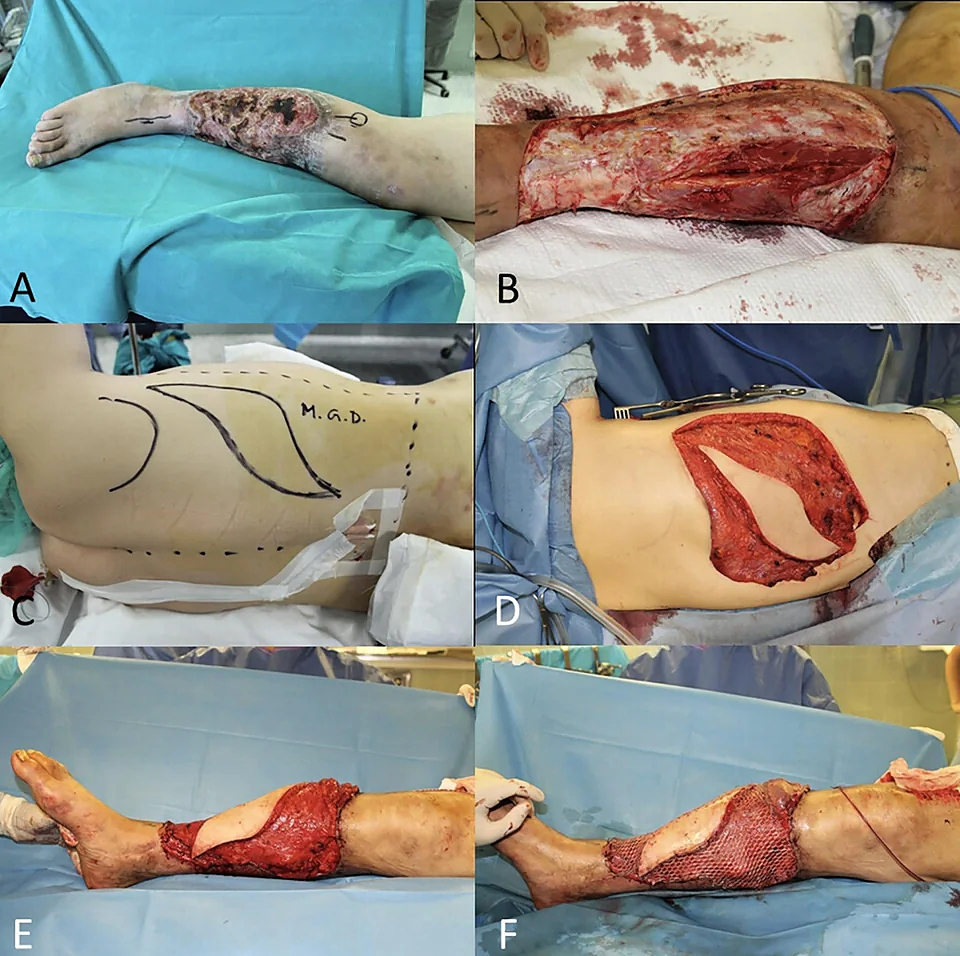 Locally advanced squamous cell carcinomas