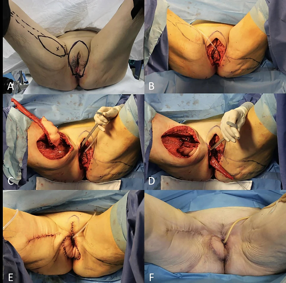 Locally advanced squamous cell carcinomas
