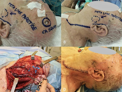 Locally advanced squamous cell carcinomas
