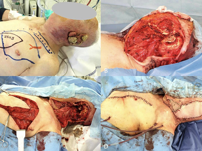 Locally advanced squamous cell carcinomas