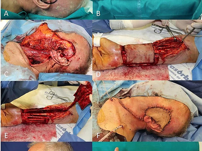 Locally advanced squamous cell carcinomas