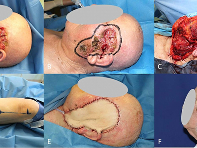 Locally advanced squamous cell carcinomas