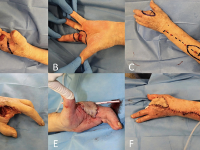 Locally advanced squamous cell carcinomas