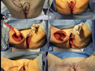 Locally advanced squamous cell carcinomas