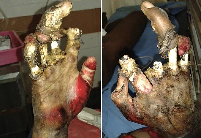 High Voltage electrical burns