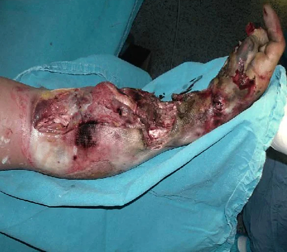 High Voltage electrical burns