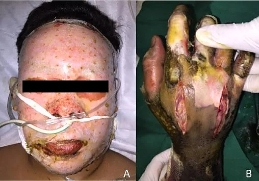 High Voltage electrical burns