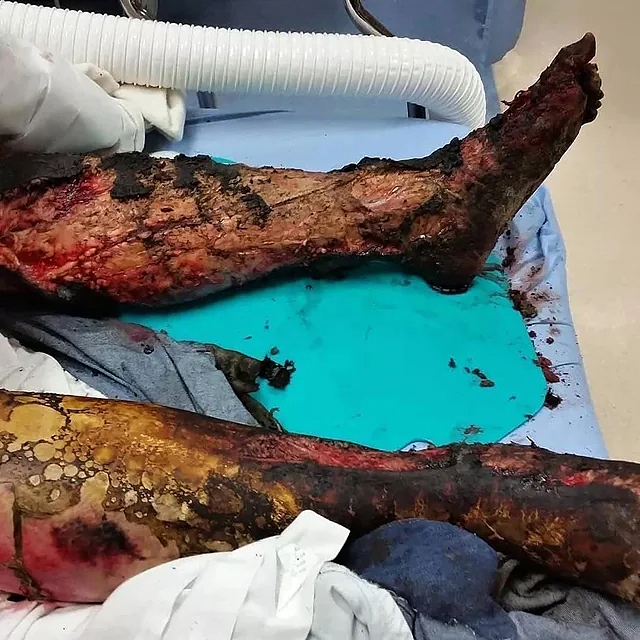 High Voltage electrical burns