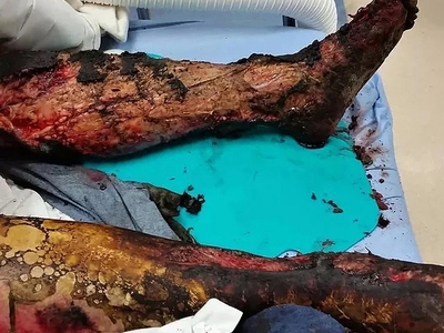 High Voltage electrical burns