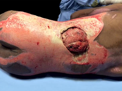 High Voltage electrical burns