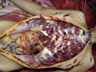 Woman stabbed to death with a partial autopsy at the scene