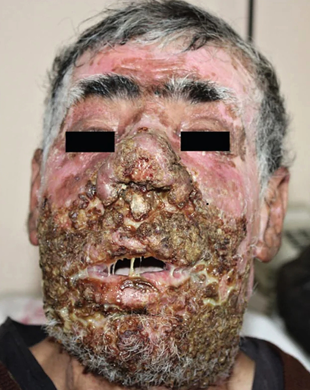 Mucocutaneous Leishmaniasis