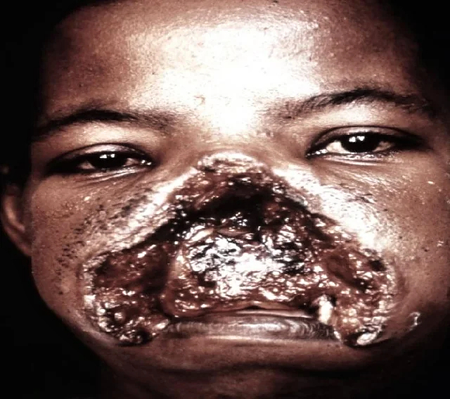 Mucocutaneous Leishmaniasis