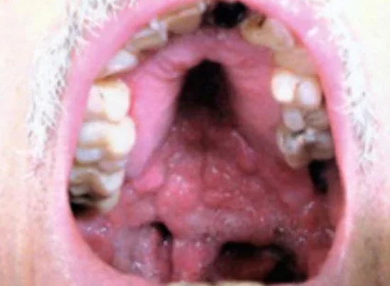 Mucocutaneous Leishmaniasis