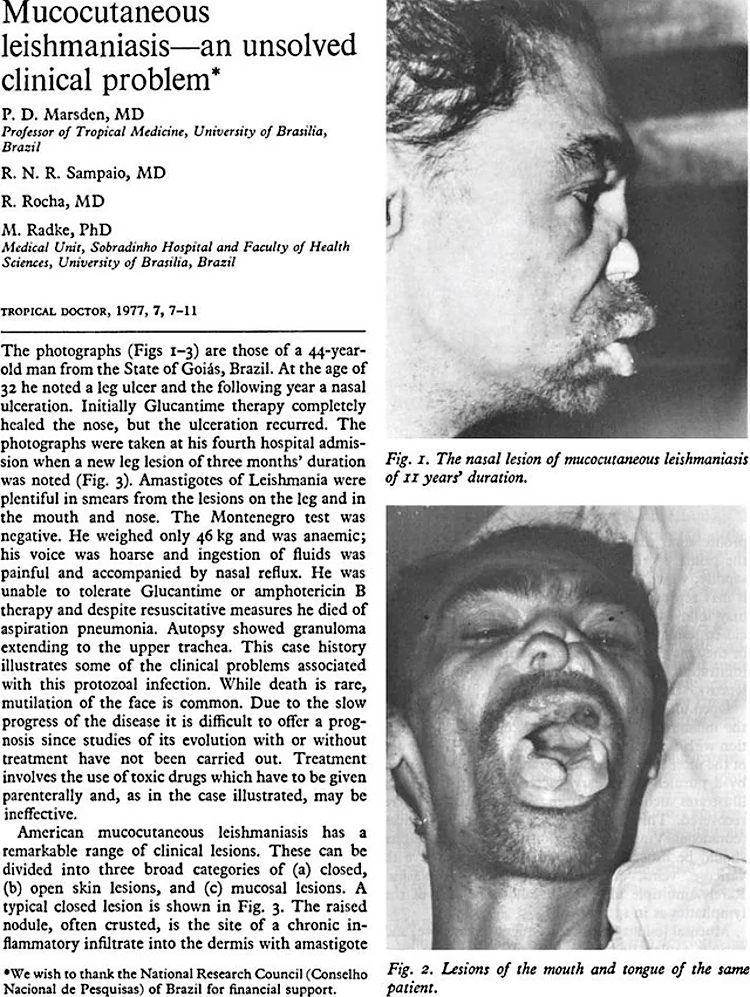 Mucocutaneous Leishmaniasis